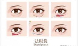 去眼袋手术过程视频,专业解析与真实体验
