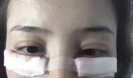 去眼袋手术过程视频,专业解析与真实体验
