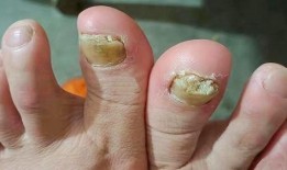 治疗灰指甲视频,跟随视频学习专业护理方法