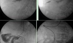 鼻肠管置入视频,鼻肠管置入操作步骤及要点解析
