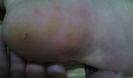 鸡眼去除视频,专业去除方法大揭秘