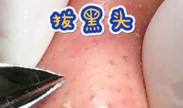 黑头清理视频,轻松告别毛孔堵塞，还原清爽肌肤
