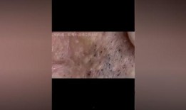 黑头清理视频,轻松告别毛孔堵塞，还原清爽肌肤