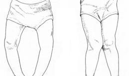 日本x型腿矫正视频,轻松掌握矫正技巧