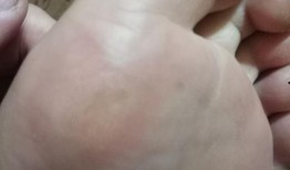 鸡眼去除视频,专业去除方法大揭秘