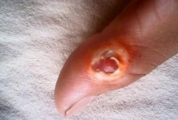 鸡眼去除视频,专业去除方法大揭秘