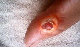 鸡眼去除视频,专业去除方法大揭秘