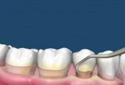 洗牙视频全过程,从准备到结束的全方位体验