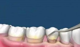 洗牙视频全过程,从准备到结束的全方位体验