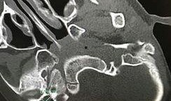 巨大耳屎视频,巨型耳屎视频引发网友热议